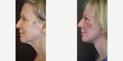 CO2 Laser before and after photo