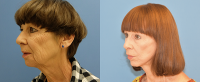 Facelift before and after photo