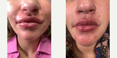 Lip Fillers before and after photo