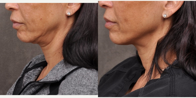 Nonsurgical Neck Lift before and after photo
