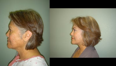 QuickLift before and after photo