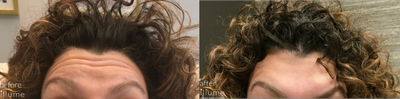 Botox before and after photo