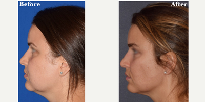 Buccal Fat Removal before and after photo