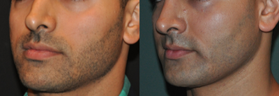 Cheek Implants before and after photo