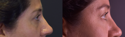 Eyelid Surgery before and after photo