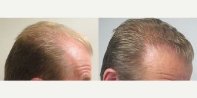 Hair Transplant before and after photo