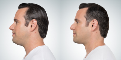 Kybella before and after photo