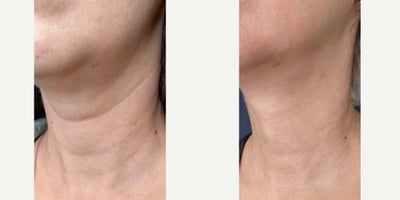 before and after image