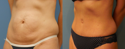Mini Tummy Tuck before and after photo