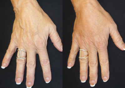 Radiesse before and after photo