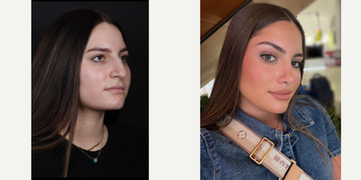 Rhinoplasty before and after photo