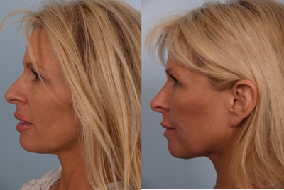 Rhinoplasty before and after photo
