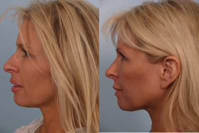 Rhinoplasty before and after photo
