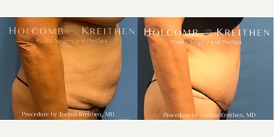 Tummy Tuck before and after photo