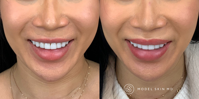 Botox for Gummy Smile before and after photo