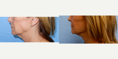 Facelift before and after photo