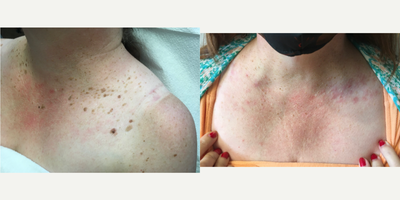 Skin Rejuvenation before and after photo