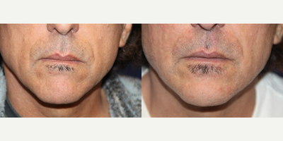 Facial Fat Transfer before and after photo