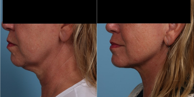 before and after image