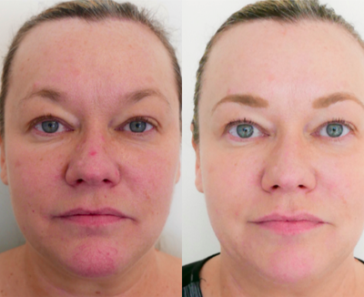 IPL before and after photo
