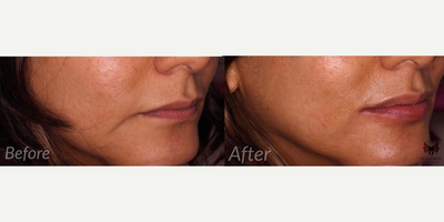 Juvederm before and after photo
