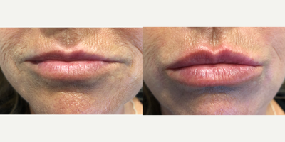 Lip Fillers before and after photo