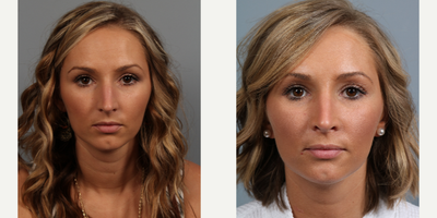Rhinoplasty before and after photo