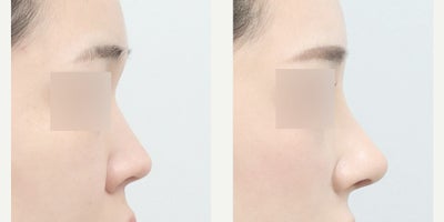 Rhinoplasty before and after photo