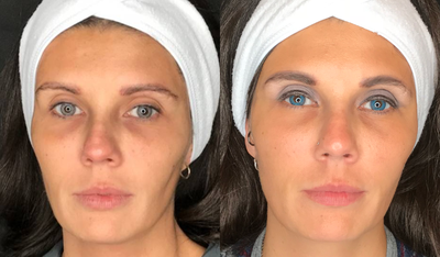 Skin Rejuvenation before and after photo