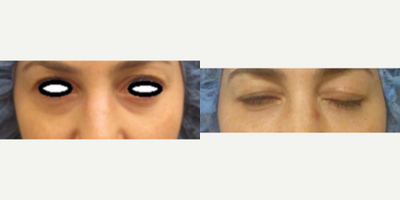 Belotero before and after photo