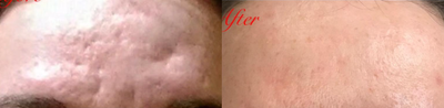 Dermal Fillers before and after photo