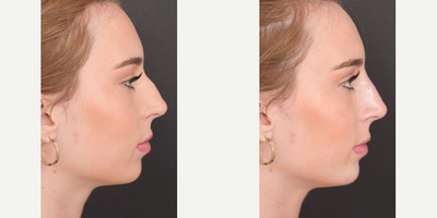 Juvederm before and after photo