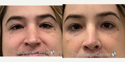Rhinoplasty before and after photo