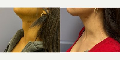before and after image