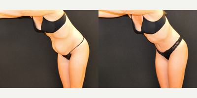 Drainless Tummy Tuck before and after photo