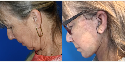 Facelift before and after photo