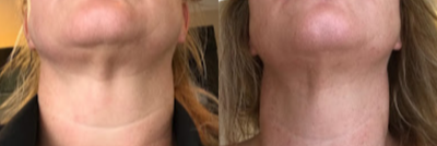 Fractora RF before and after photo