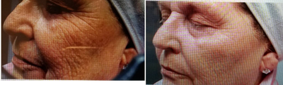 HydraFacial before and after photo