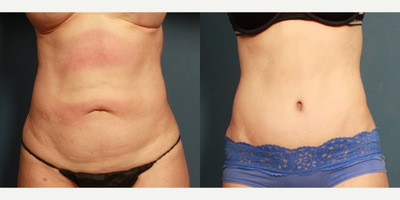 Tummy Tuck before and after photo