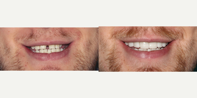 Dental Crown before and after photo