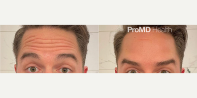 Dysport before and after photo