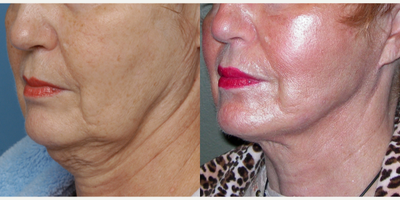 Facelift before and after photo