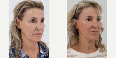 Facelift before and after photo