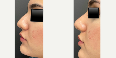 Nonsurgical Nose Job before and after photo