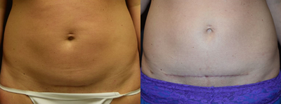 Tummy Tuck before and after photo