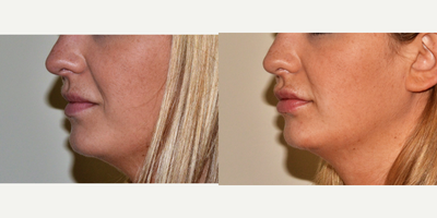 Dermal Fillers before and after photo