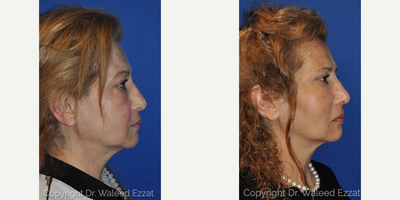 Eyelid Surgery before and after photo