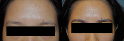 Eyebrow Transplant before and after photo