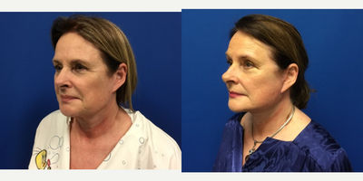 Facelift before and after photo
