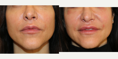 Lip Implants before and after photo
